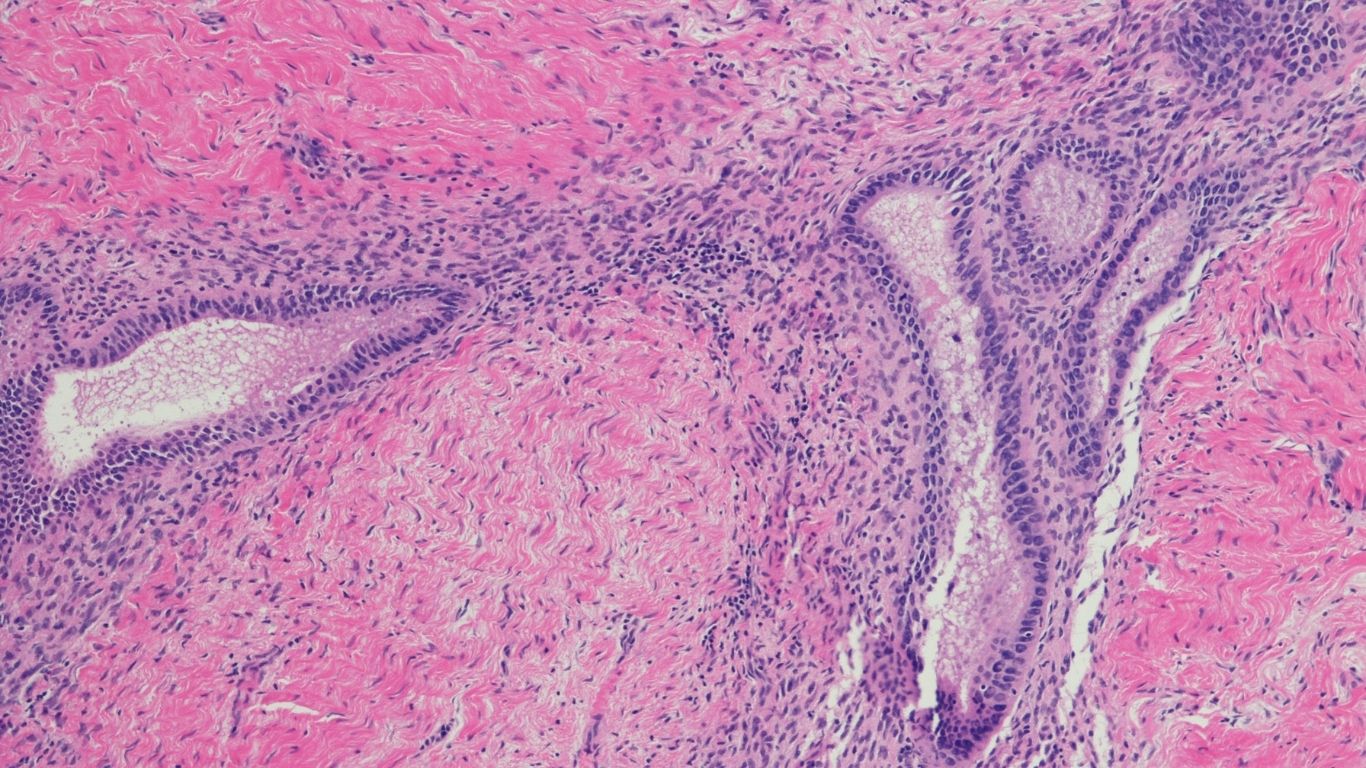 Endométriose