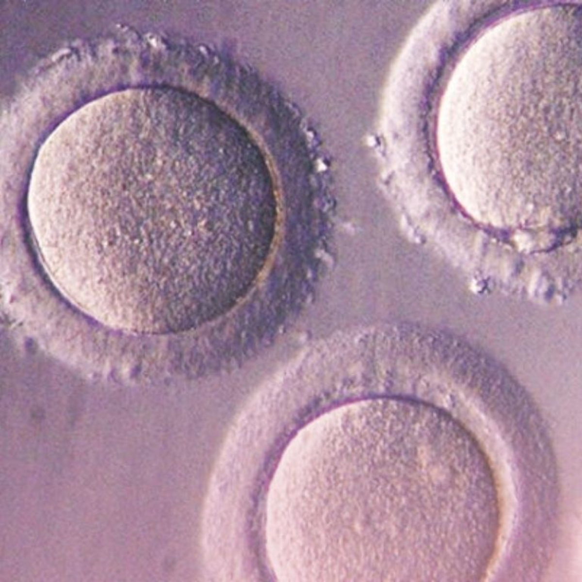SOPK rebaptisé SMOP : ce que ce changement historique signifie vraiment pour votre fertilité?