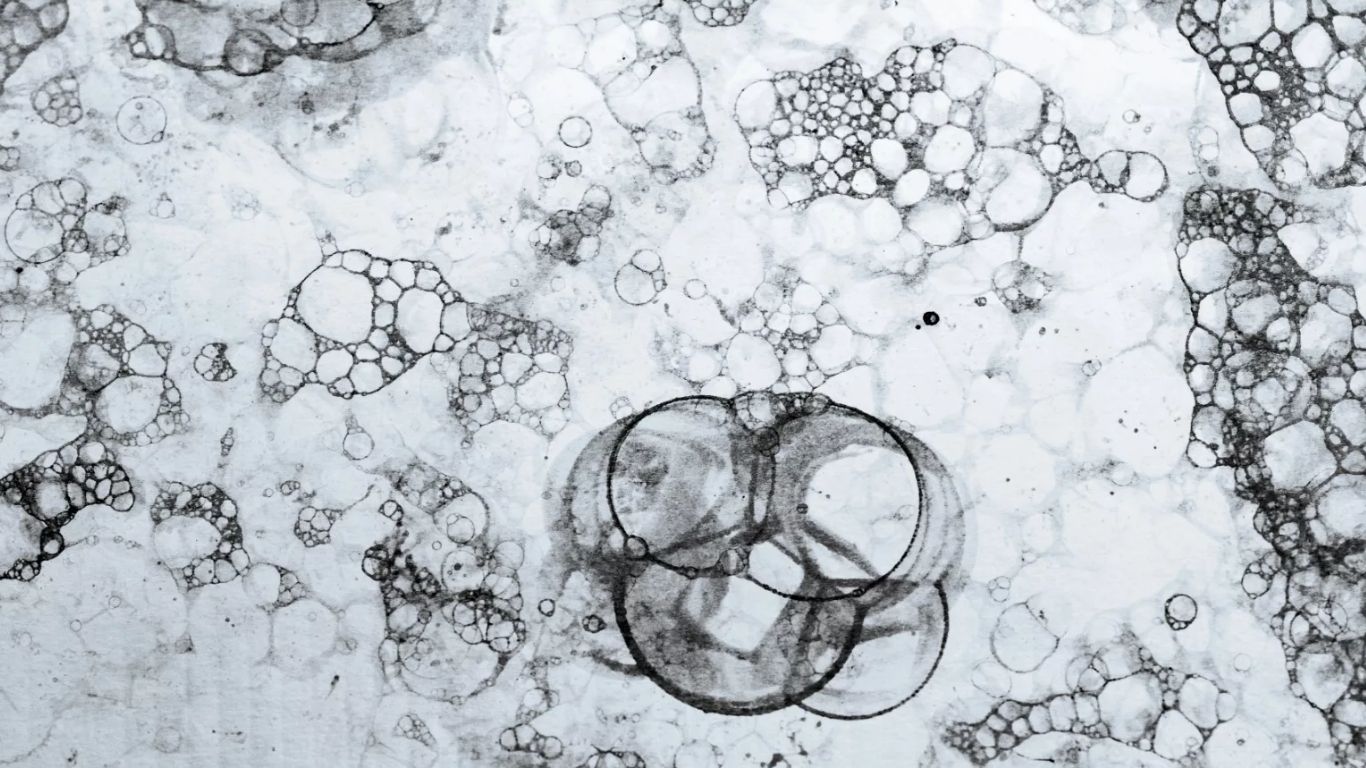 SOPK Syndrome des ovaires polykystiques